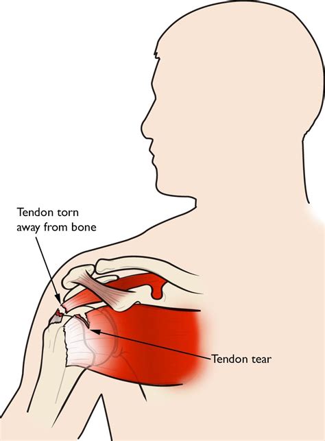 muscle tears away from bone